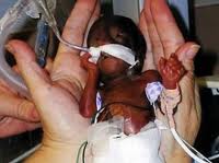 abortion premature baby 2